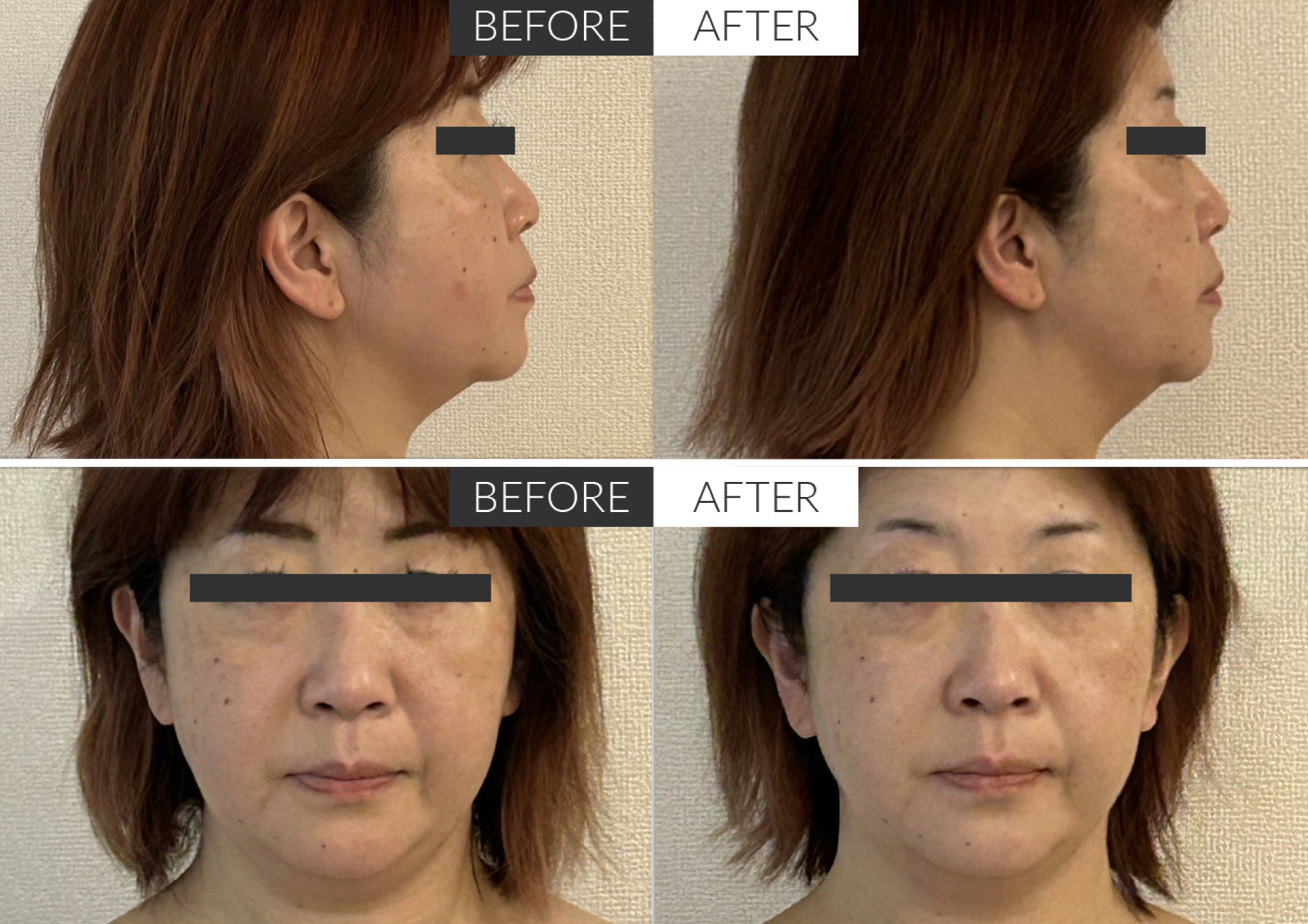 FACIAL SCULPTING ビフォアアフター